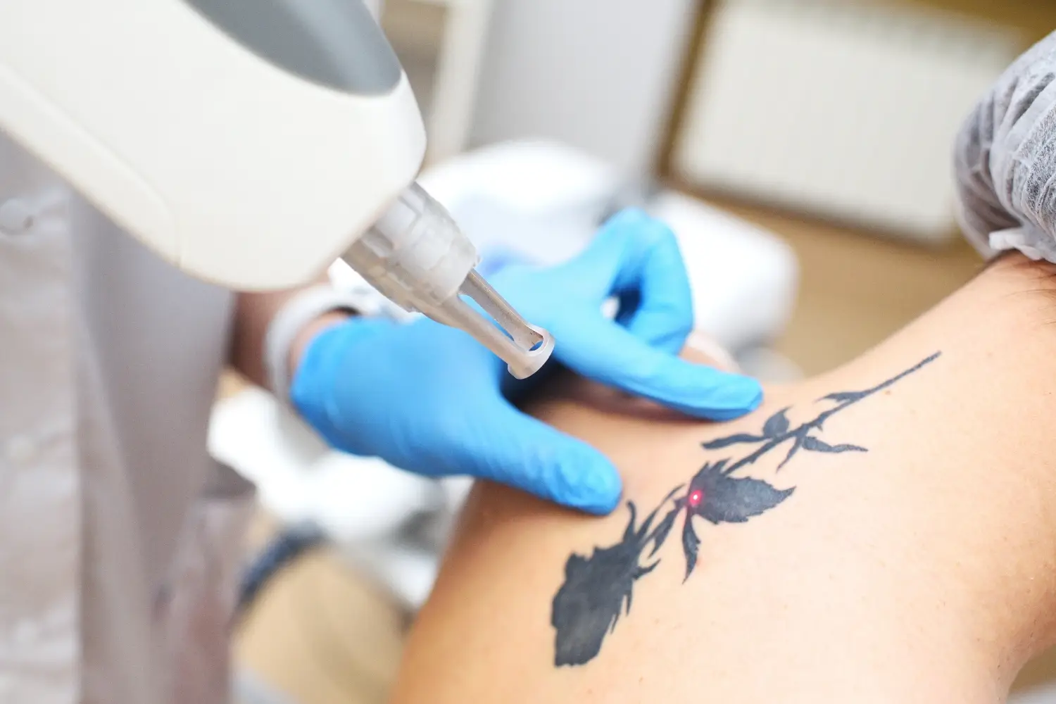Practitioner using a handheld laser device to remove a floral tattoo from a client’s upper arm.
