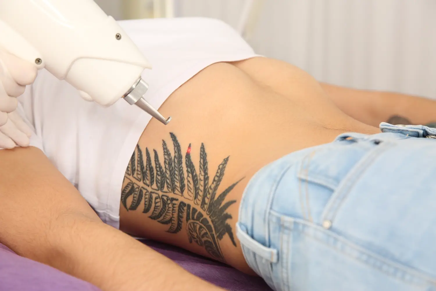 Practitioner using a laser device to treat a large black tattoo on a client’s hip.