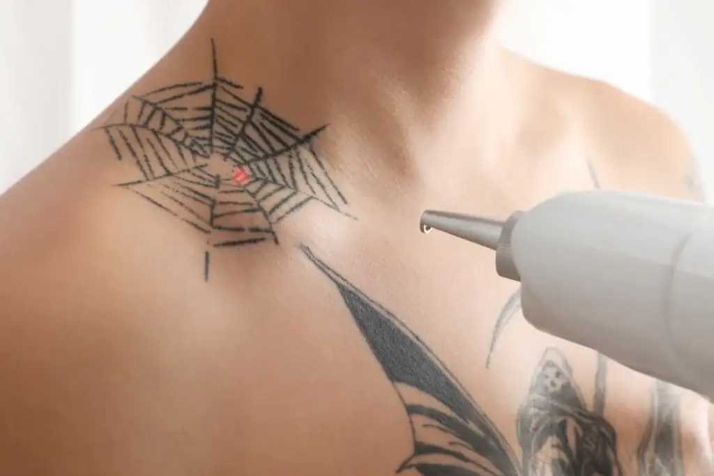Practitioner using a laser device to treat a spiderweb tattoo on a client’s shoulder.